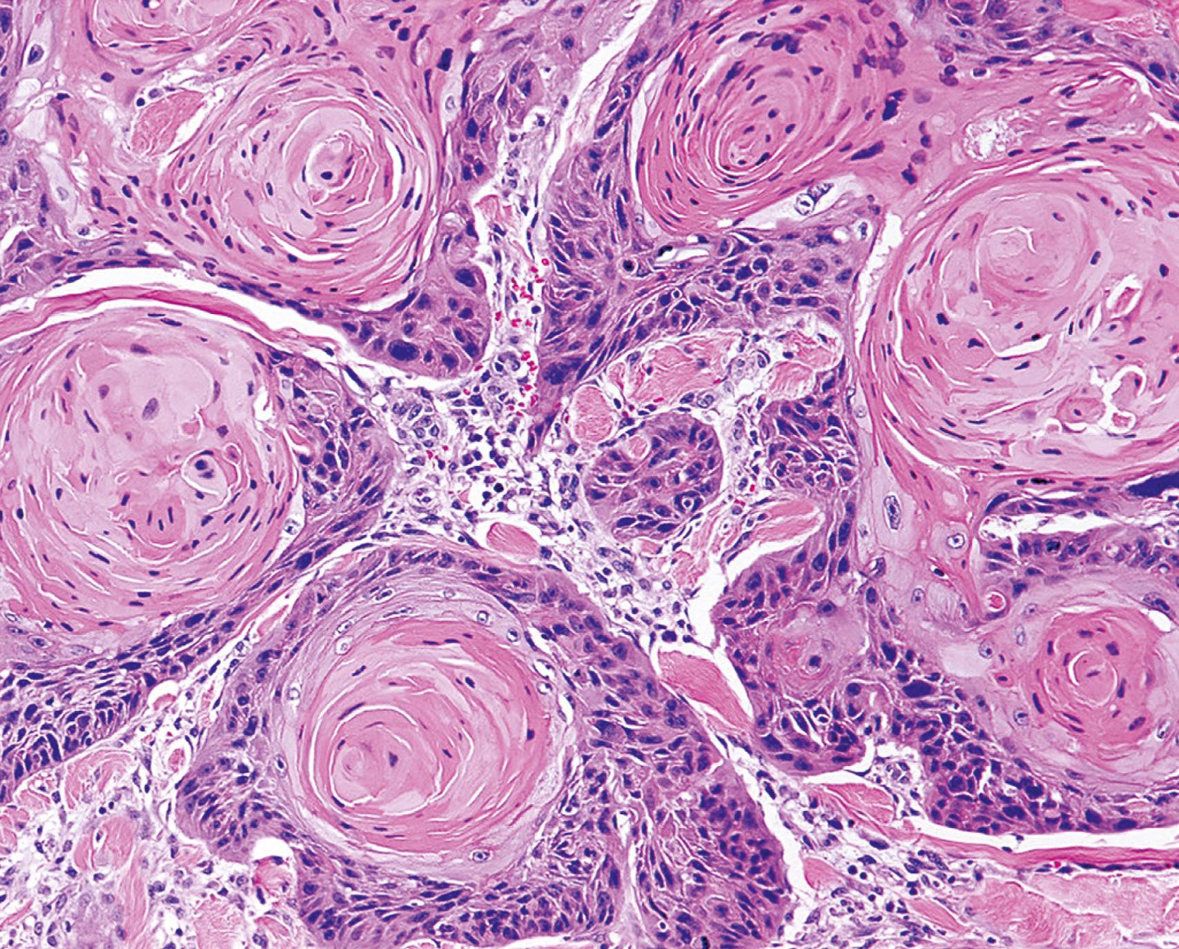 FIG. 6.3, Well-differentiated squamous cell carcinoma of the skin. Note the terminal differentiation of the tumor cells, which are forming keratin pearls.