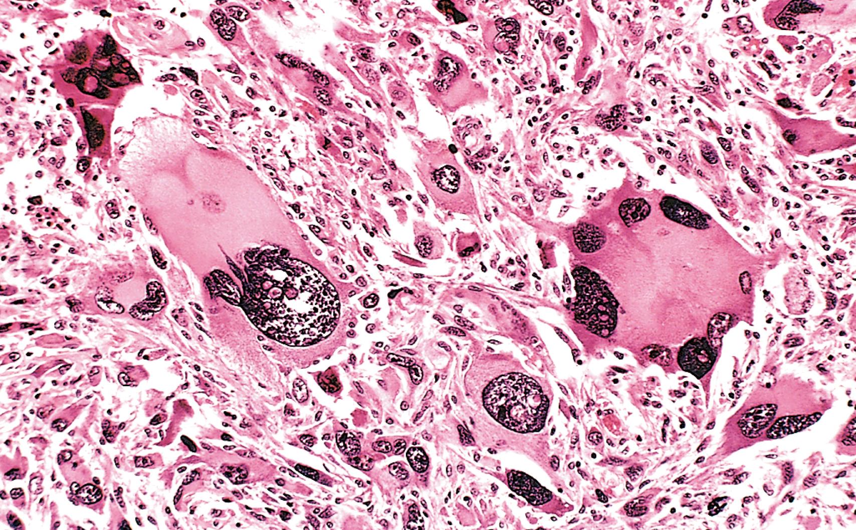 FIG. 6.4, Pleomorphic malignant tumor (rhabdomyosarcoma). Note the marked variation in cell and nuclear sizes, the hyperchromatic nuclei, and the presence of tumor giant cells.