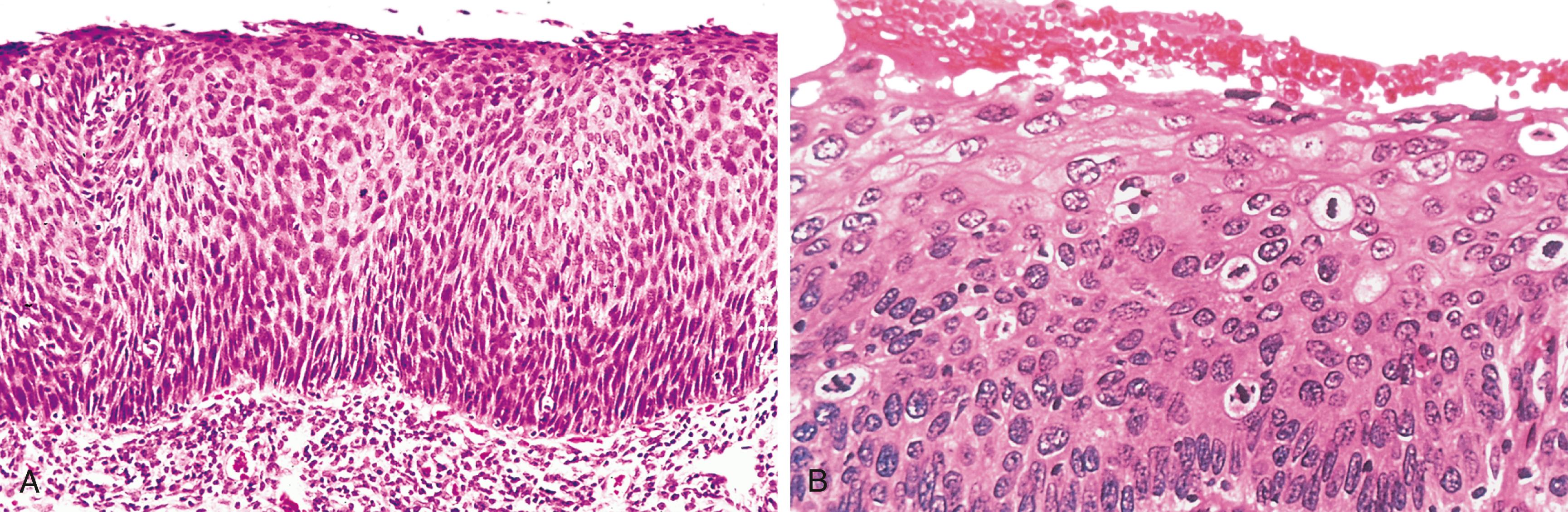 FIG. 6.6, Carcinoma in situ. (A) Low-power view shows that the entire thickness of the epithelium is replaced by atypical dysplastic cells. There is no orderly differentiation of squamous cells. The basement membrane is intact, and there is no tumor in the subepithelial stroma. (B) High-power view of another region shows failure of normal differentiation, marked nuclear and cellular pleomorphism, and numerous mitotic figures extending toward the surface. The intact basement membrane (below) is not seen in this section.