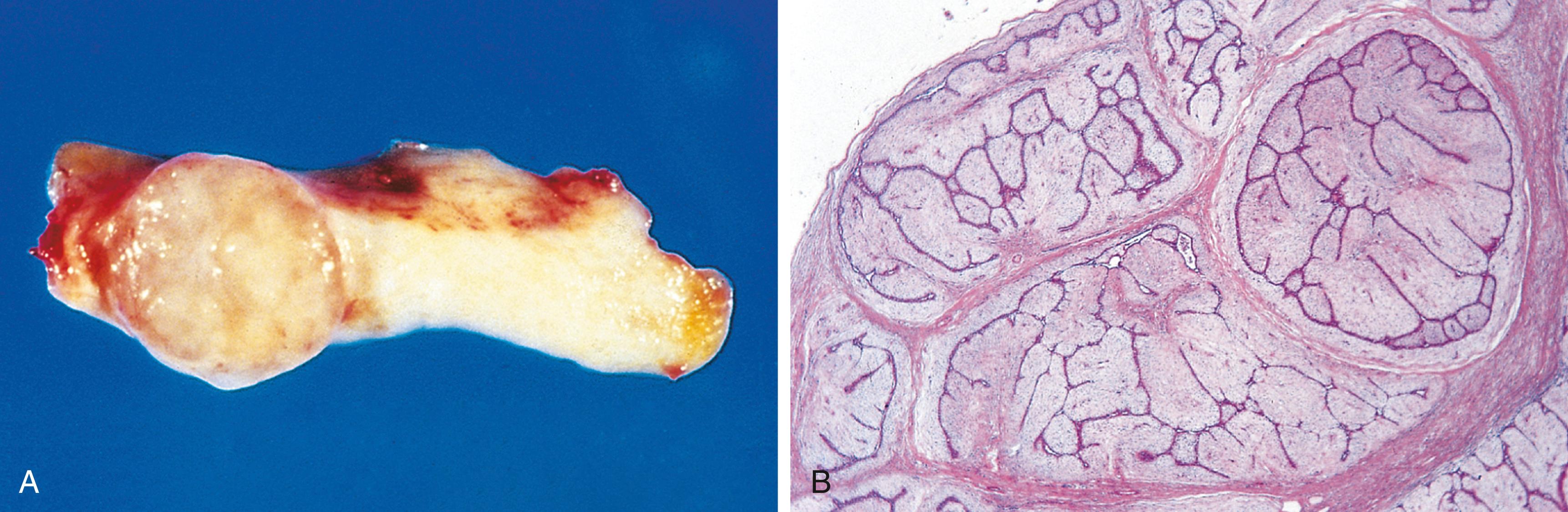 FIG. 6.7, Fibroadenoma of the breast. (A) The tan, encapsulated tumor is sharply demarcated from surrounding white breast tissue. (B) A microscopic view shows cords of entrapped dark staining epithelium compressed by a loose fibrous stroma surrounded by bands of collagen.