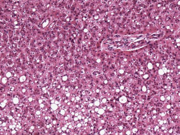 Fig. 11.1, Hepatocellular adenoma, steatotic type.