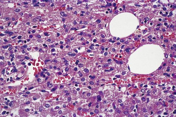 Fig. 11.11, Angiomyolipoma.