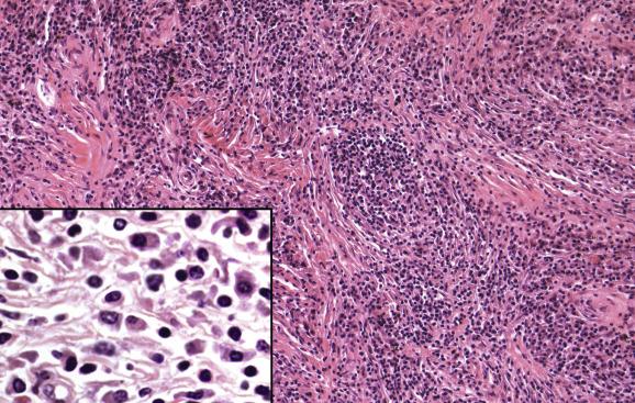 Fig. 11.12, Inflammatory pseudotumour.