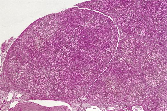 Fig. 11.13, Macroregenerative nodule.