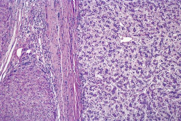 Fig. 11.14, Dysplastic nodule.