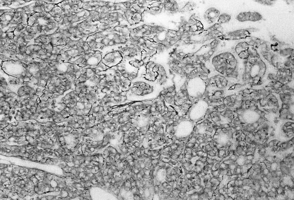 Fig. 11.16, Hepatocellular carcinoma.