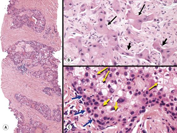 Fig. 11.17, Scirrhous hepatocellular carcinoma.