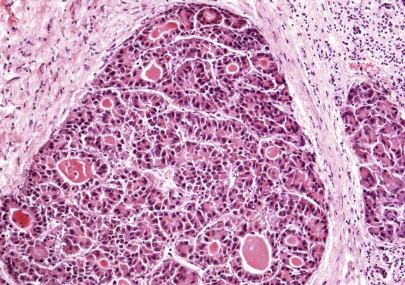 Fig. 11.18, Hepatocellular carcinoma.