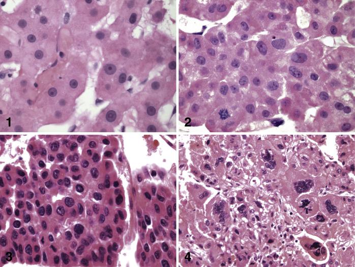 Fig. 11.20, Hepatocellular carcinoma: cytological grading.