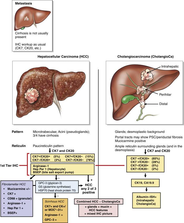 Fig. 11.21, Immunohistochemical (IHC) workup of primary malignant liver tumours.