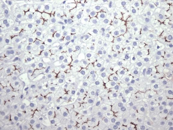 Fig. 11.22, Immunohistochemical demonstration of bile canalicular structures using an immunostain for bile-salt export pump.