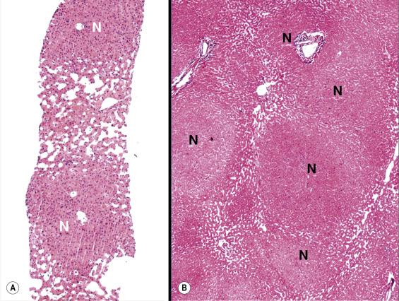 Fig. 11.6, Nodular regenerative hyperplasia.