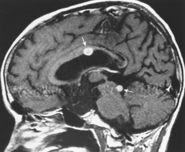 FIGURE 2-16, Subarachnoid seeding from patient Dot O’Whyte’s brain stem glioma. Postcontrast T1-weighted image shows contrast-enhancing nodules (arrows) in the roof of the lateral ventricle and in the superior vermian cistern. The keen observer will notice the “overly pregnant” belly of the pons.