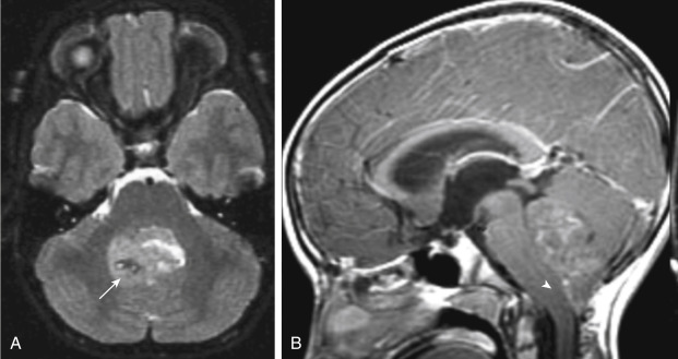 FIGURE 2-19, Fourth ventricular ependymoma. A, This mass in patient Dru Batluk fills and expands the fourth ventricle and is heterogeneous on T2-weighted image. The low signal area marked by the arrow is a focus of calcification. B, Note how the lesion oozes through the foramen of Magendie (arrowhead) to squirt into the cervicomedullary junction.