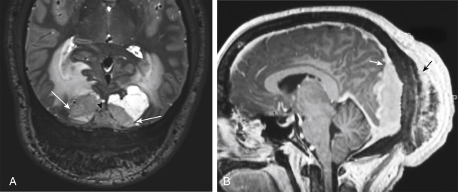 FIGURE 2-3, Parasagittal meningioma. A, Patient Doris Tuwyde’s meningioma (white arrows) is isointense on T2WI but one also has the adjacent bright intraaxial vasogenic edema. Because the lesion crosses the midline outside a normal white matter tract and is invading the dura of the superior sagittal sinus (black arrowhead), it is clearly extraaxial. Oh, and the bone and scalp also are invaded too. B, Add a dural tail, tumor growth along the sagittal sinus (white arrow), bone reaction (black arrow), and strong enhancement and you should be dictating this case as a meningioma.