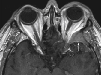 FIGURE 2-5, Intraosseous meningioma. Enhanced T1-weighted image of patient Ina D. Bowen demonstrates evidence of an intraosseous meningioma expanding the left sphenoid wing (white arrow). The patient has mild proptosis and a small amount of intraorbital soft tissue. The differential diagnosis would include a metastasis and fibro-osseous primary bone lesions.