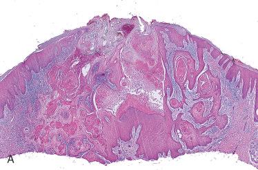 Fig. 24-1, Keratacanthoma.