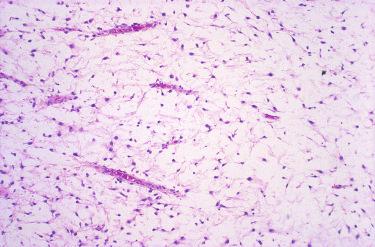 Fig. 24-11, External auditory canal myxoma.