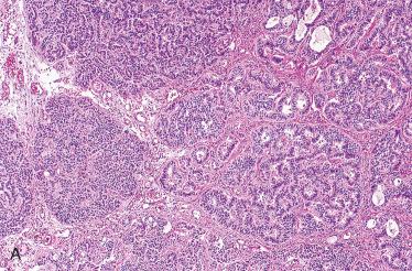 Fig. 24-12, Middle ear adenoma.