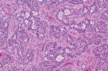 Fig. 24-13, Middle ear adenoma.