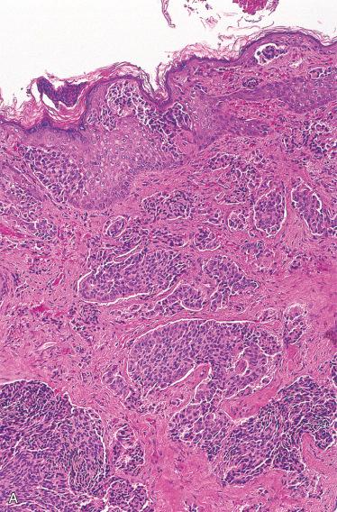 Fig. 24-14, Middle ear adenoma.