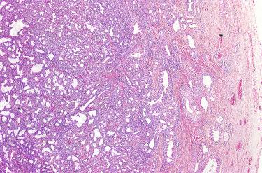 Fig. 24-3, Ceruminal gland adenoma.