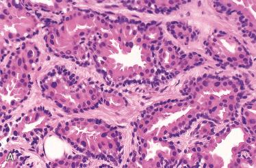 Fig. 24-4, Ceruminal gland adenoma.