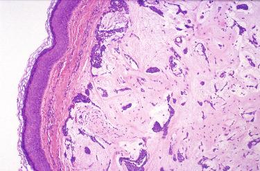 Fig. 24-5, Ceruminal gland pleomorphic adenoma.