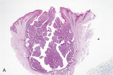 Fig. 24-7, Syringocystadenoma papilliferum.