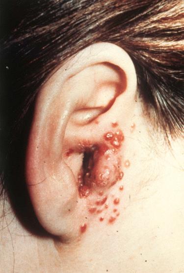 Fig. 24-8, Epithelioid hemangioma.