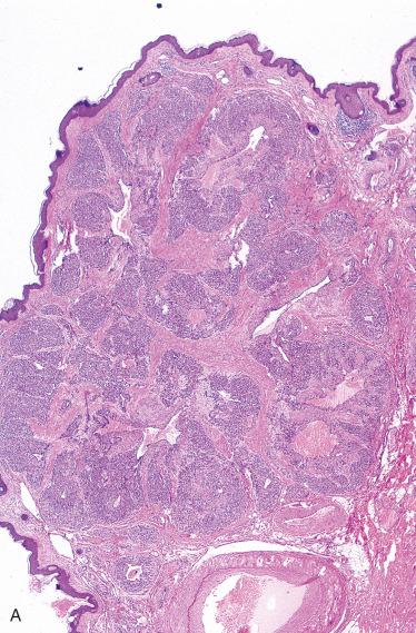 Fig. 24-9, Epithelioid hemangioma.