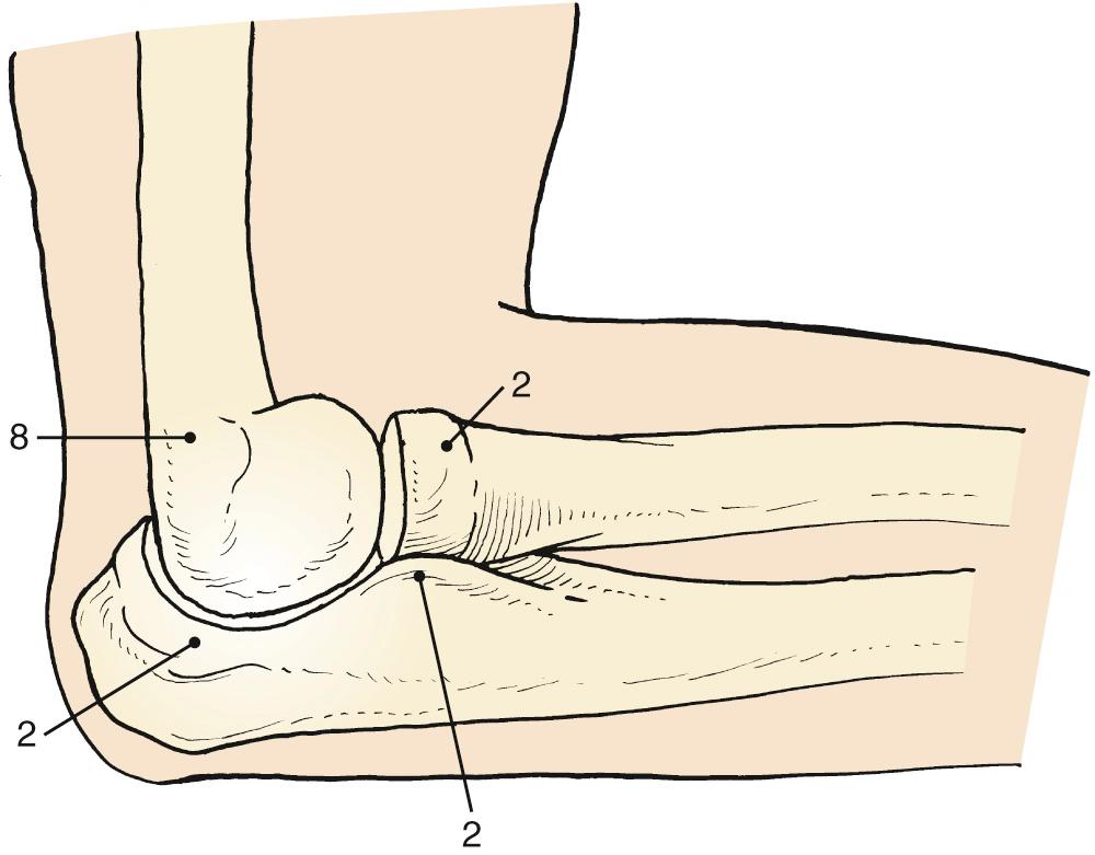 FIG 81.2, Distribution of 14 osteoid osteomas treated at the Mayo Clinic.