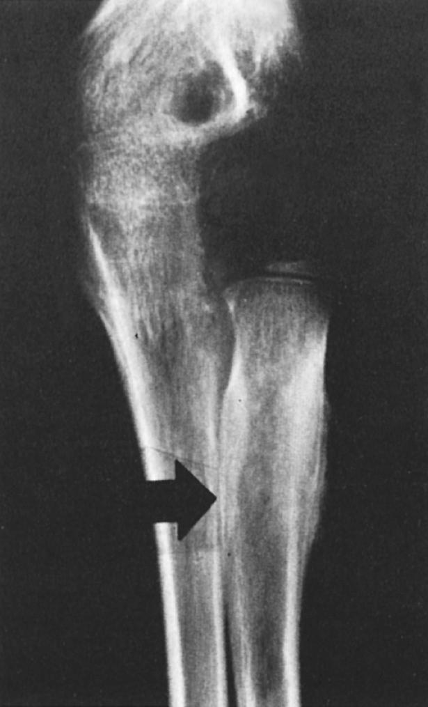 FIG 81.3, Osteoid osteoma in a 10-year-old boy, upper radial shaft. Rarefied nidus with central sclerotic area and surrounding bone formation (arrow).