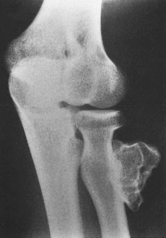 FIG 81.5, Osteochondroma in a 23-year-old woman. Radial shaft with cortical and medullary bone extending into tumor.