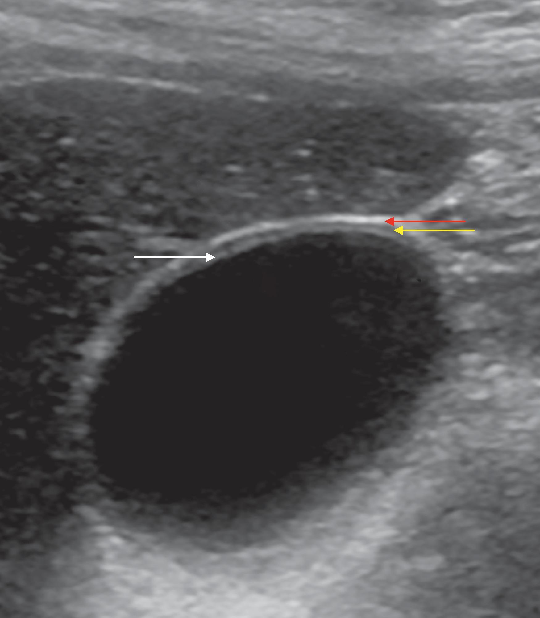 Fig. 50.1, High-resolution ultrasound (HRUS) of gallbladder.