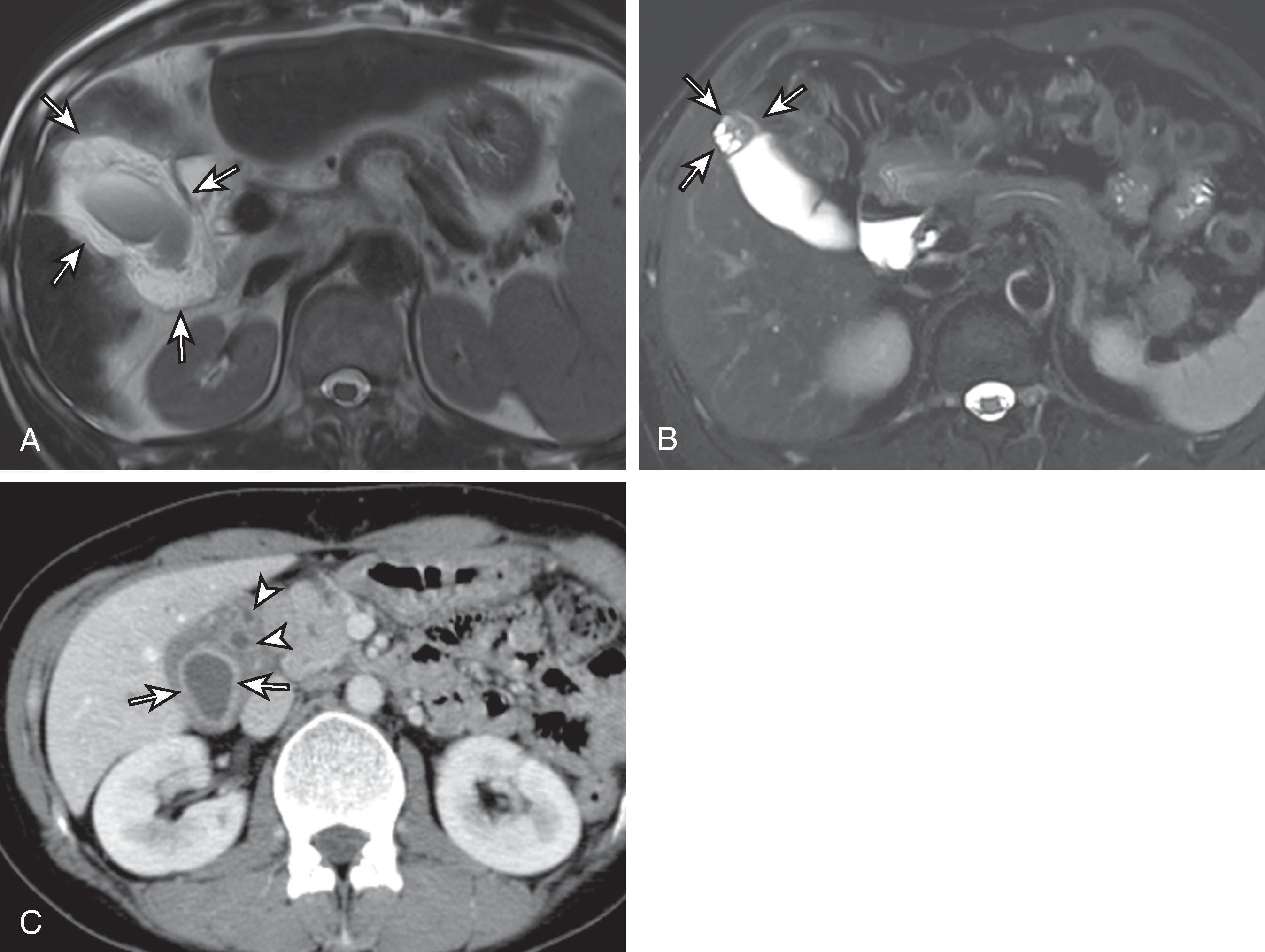 Fig. 50.11, Computed tomography (CT) and MRI features of gallbladder wall thickening of benign condition.