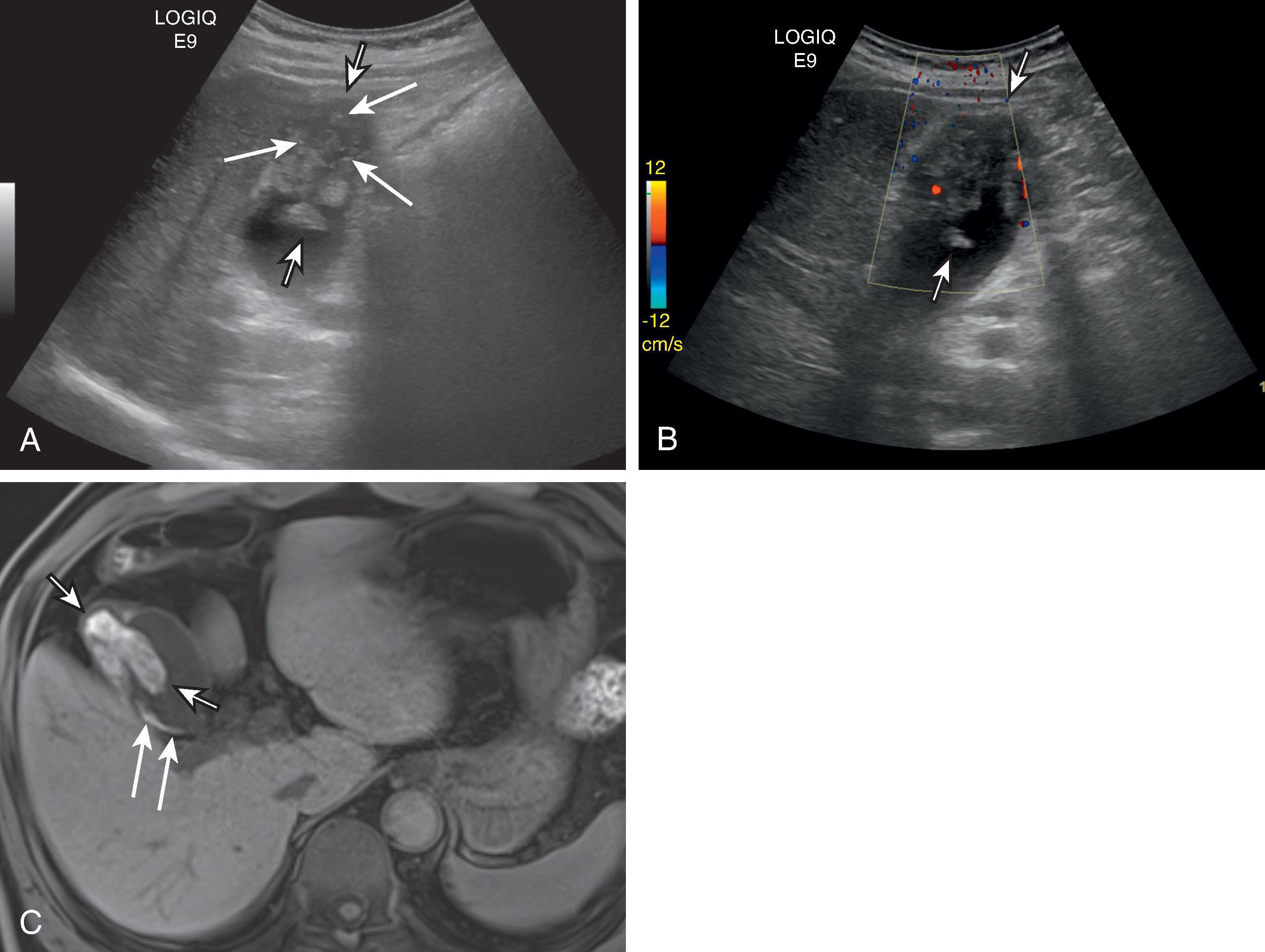 Fig. 50.12, Tumefactive sludge mimicking gallbladder carcinoma.