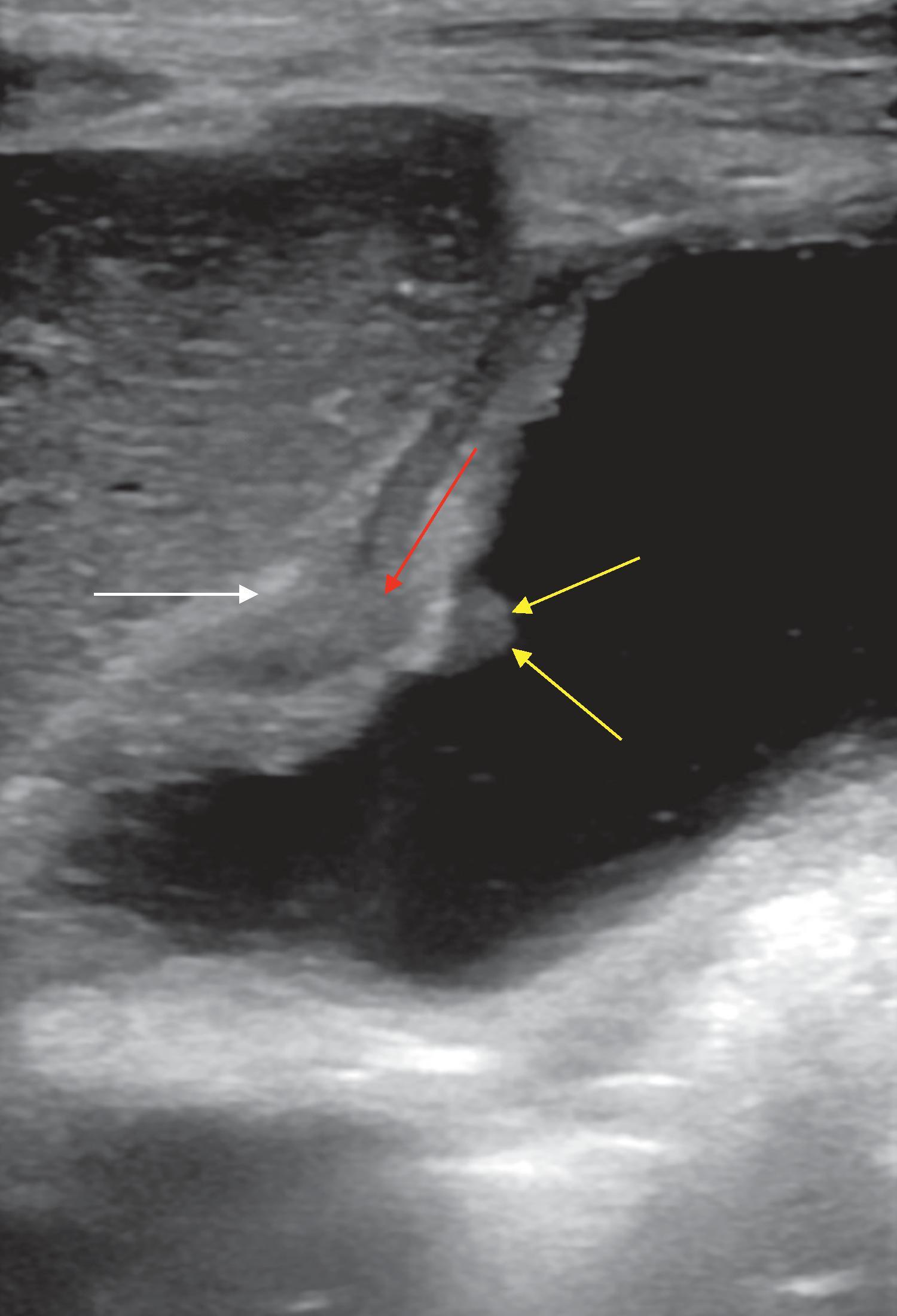 Fig. 50.2, High-resolution ultrasound (HRUS) of T2b stage of gallbladder cancer.