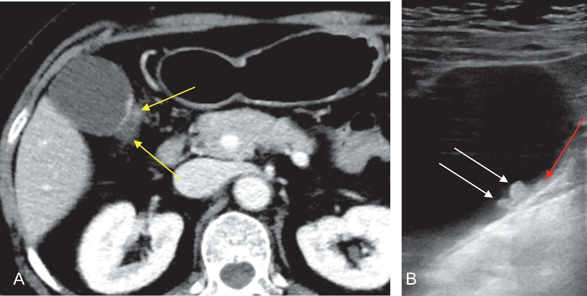 Fig. 50.3, Wall thickening type gallbladder carcinoma.