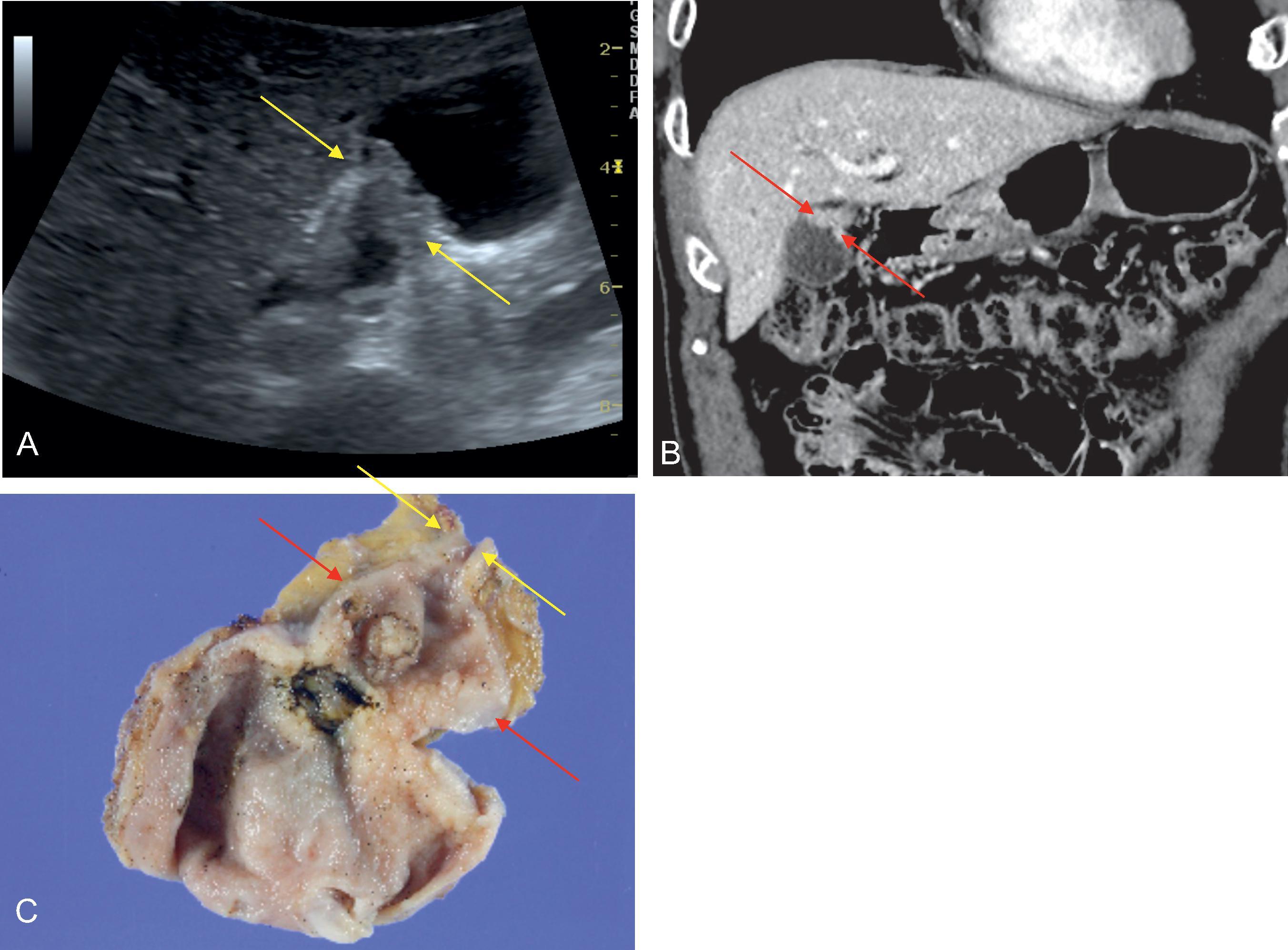Fig. 50.4, Wall thickening type gallbladder carcinoma.