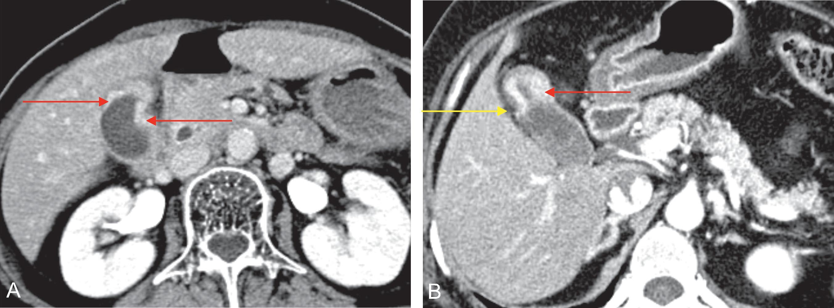 Fig. 50.5, Wall thickening type gallbladder carcinoma.