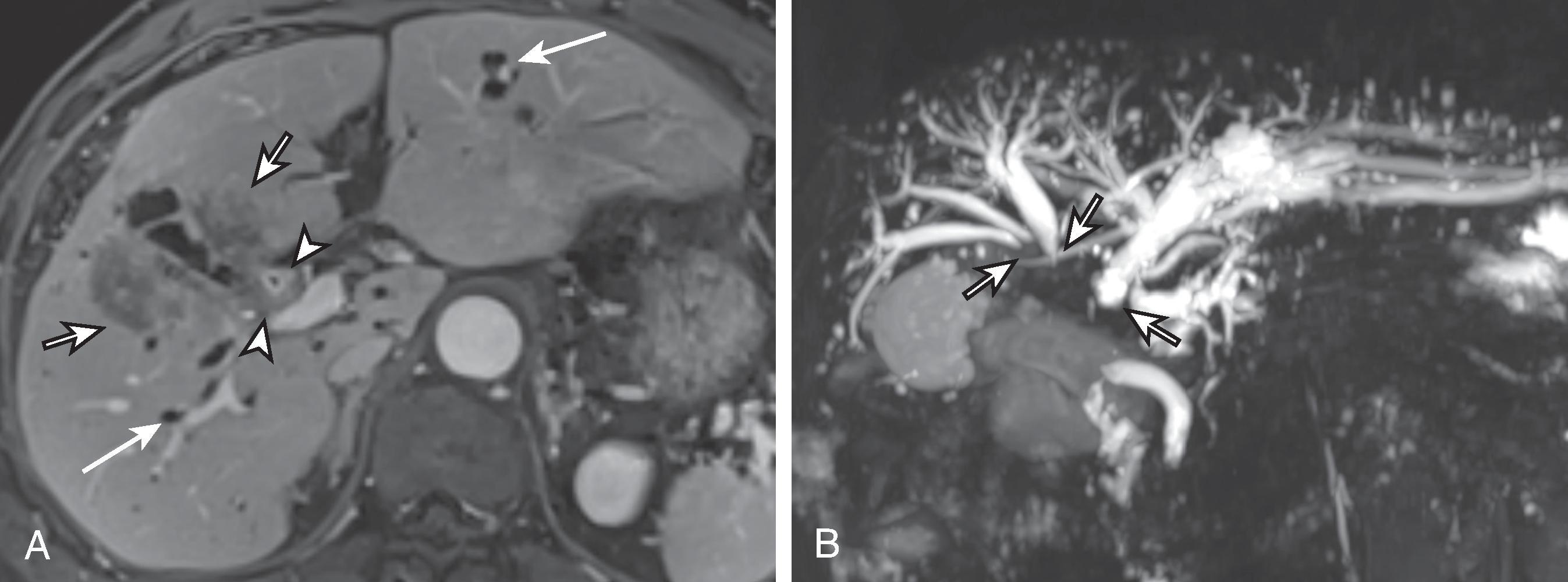 Fig. 50.6, Gallbladder carcinoma with direct spread to the bile duct.