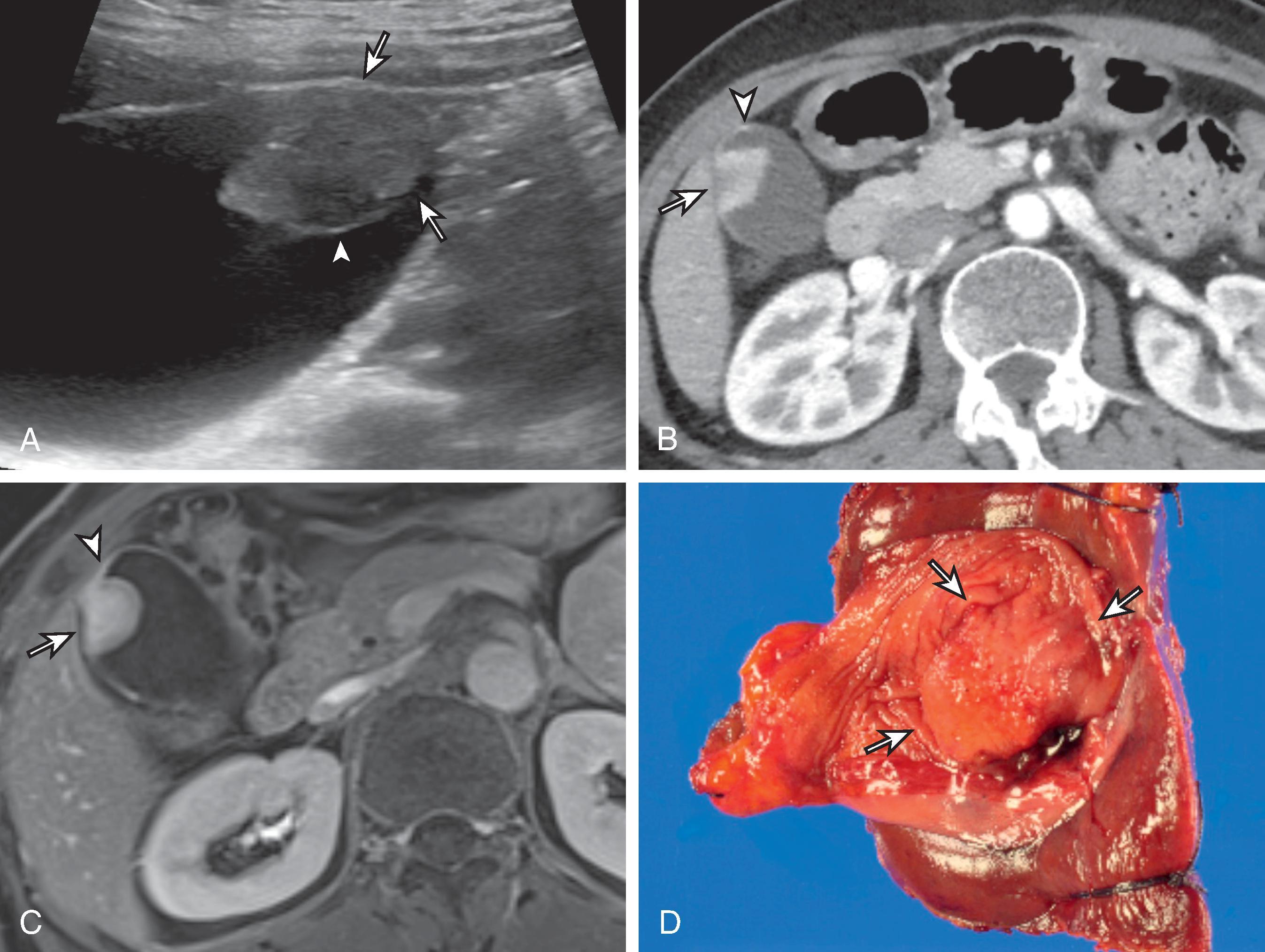 Fig. 50.7, Polypoid-type gallbladder carcinoma.