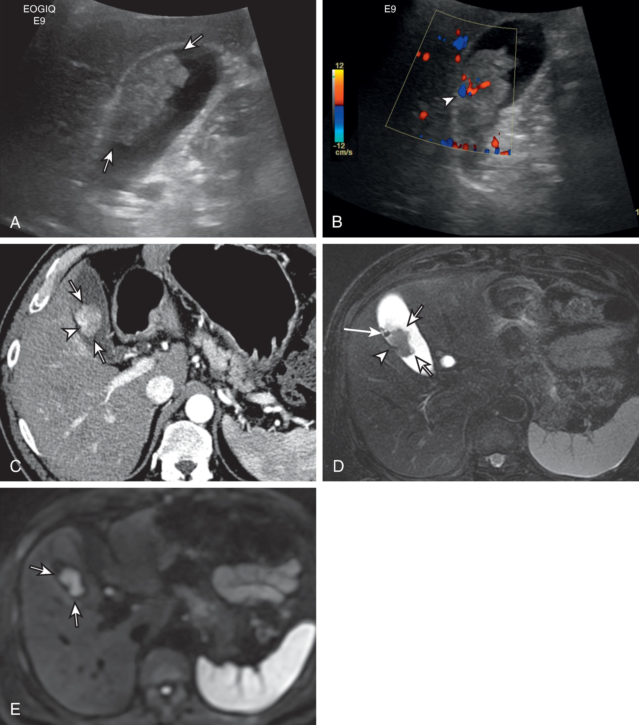 Fig. 50.8, Polypoid type gallbladder carcinoma.