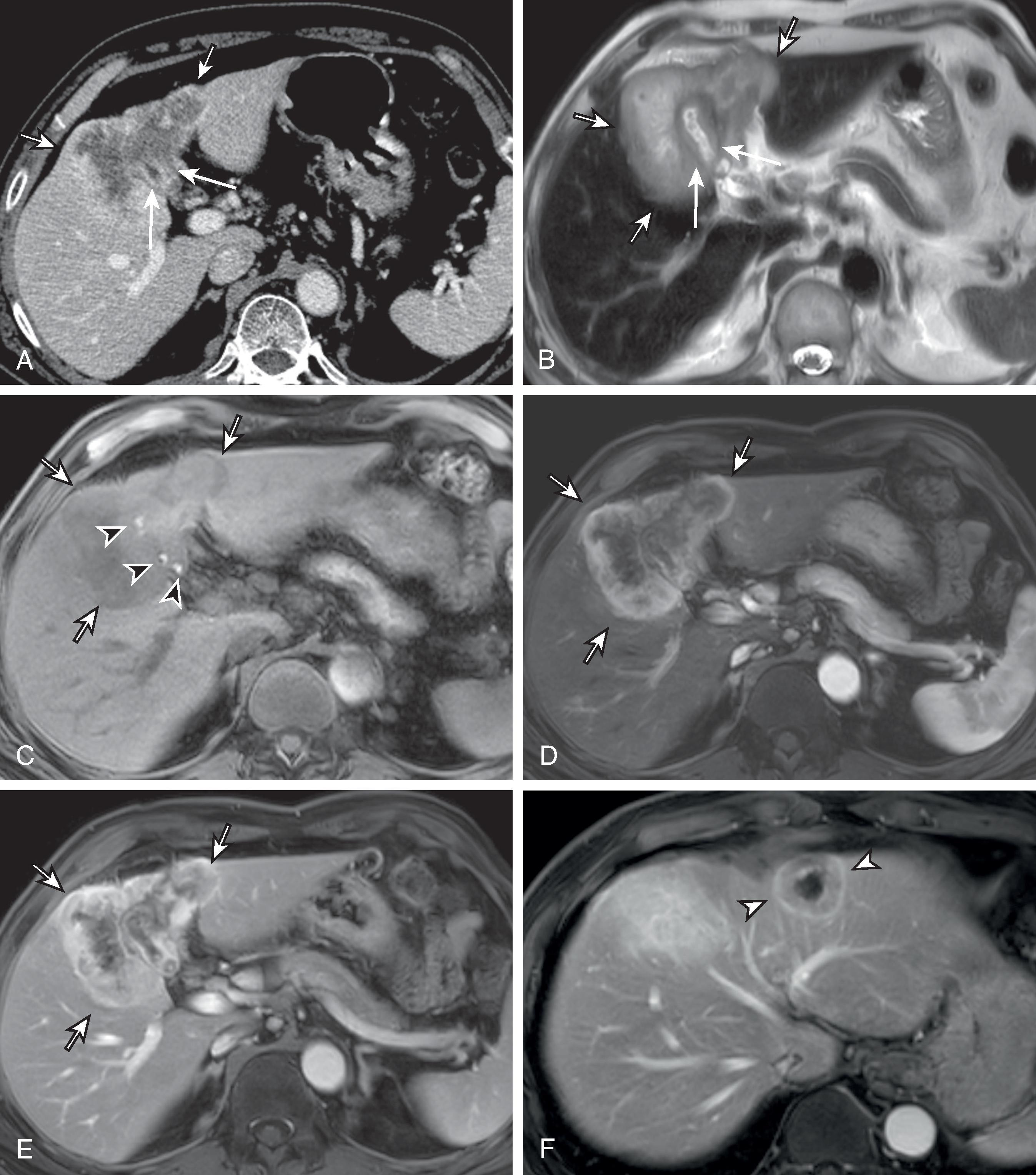 Fig. 50.9, Gallbladder carcinoma presenting as a gallbladder fossa mass.