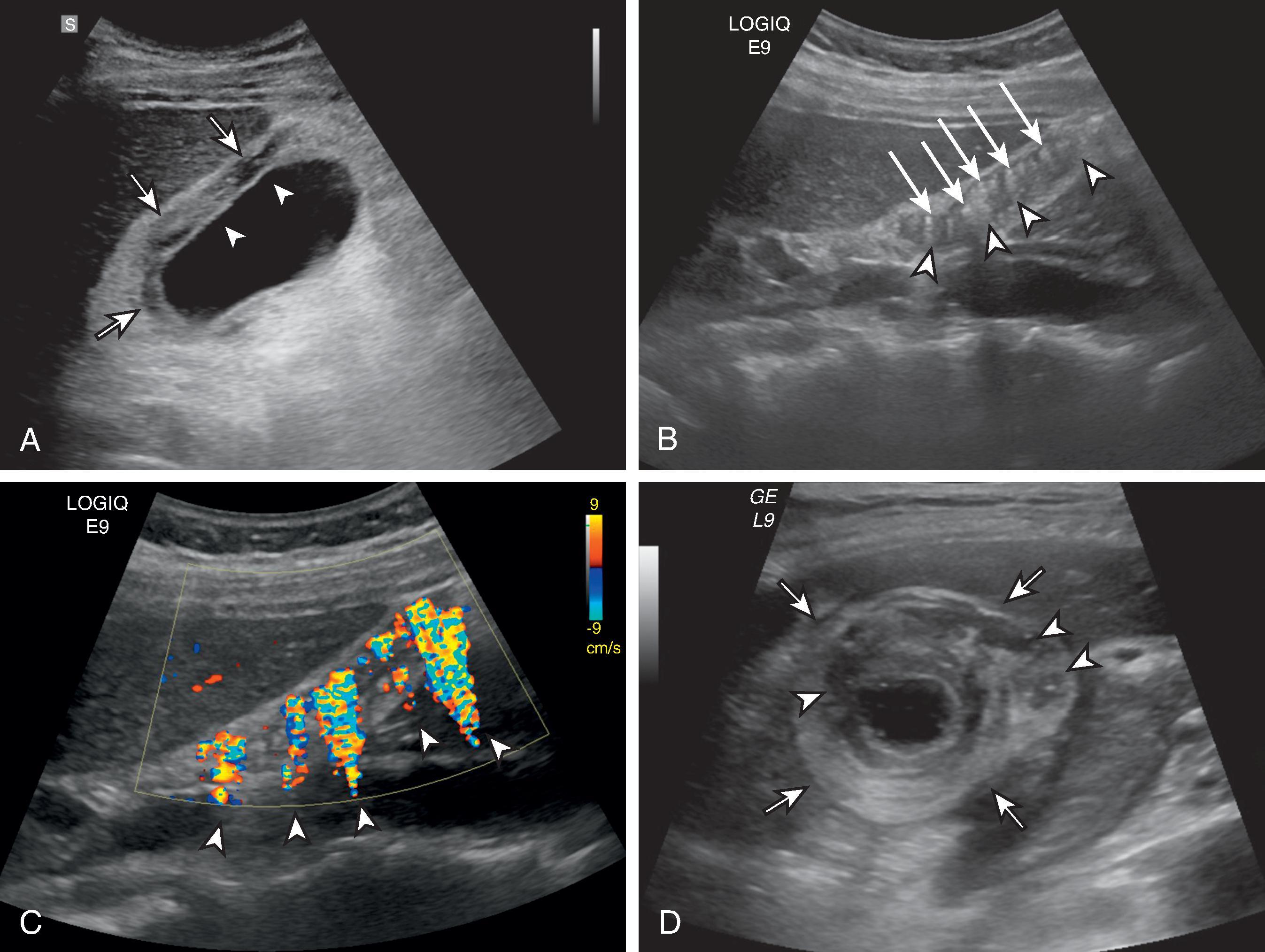 Fig. 50.10, Ultrasound (US) features of gallbladder wall thickening of benign condition.