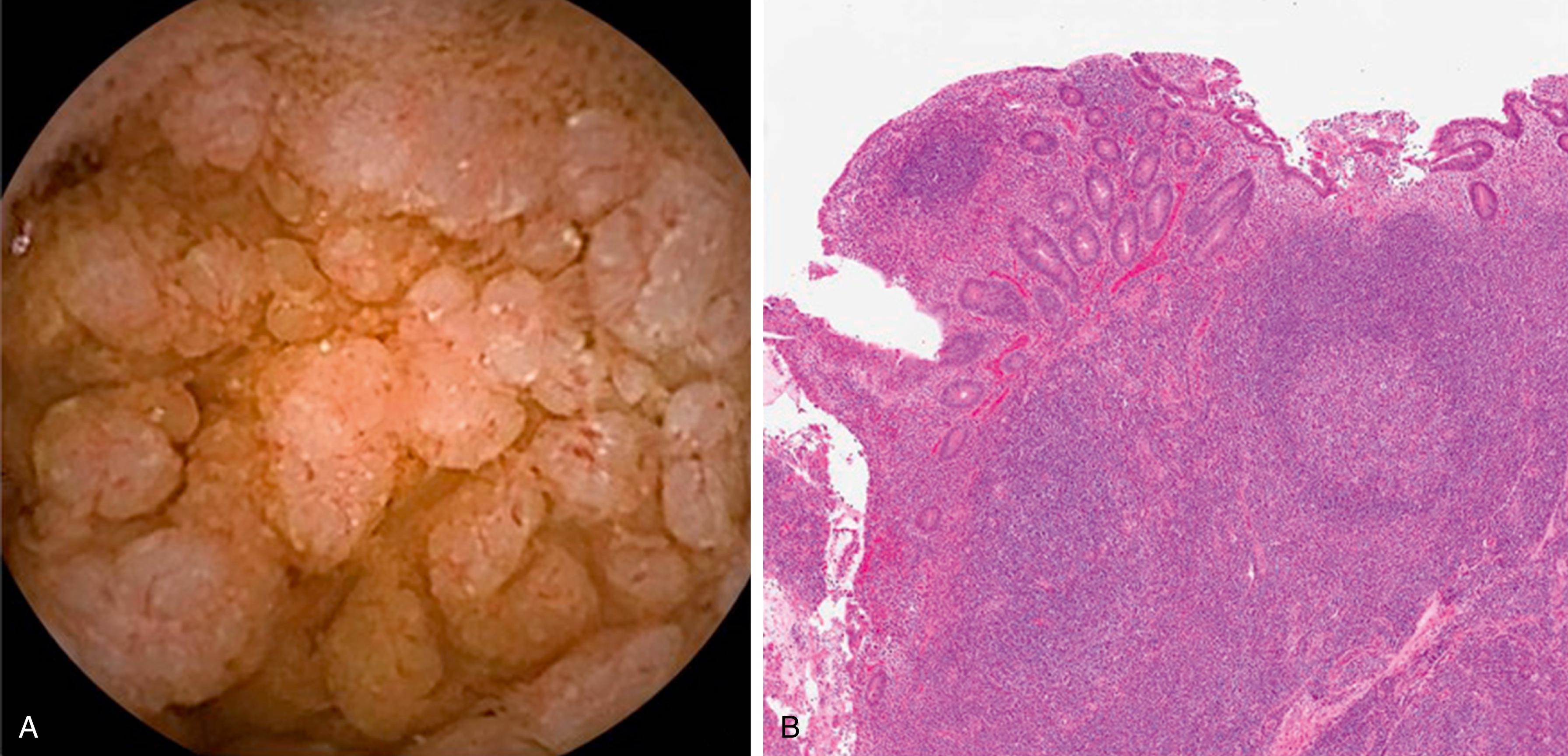 Fig. 47.1, Lymphonodular Hyperplasia. (A) Capsule endoscopy of lymphoid hyperplasia in the ileum. (B) Prominent lymphoid follicles with reactive germinal centers distort the normal villous architecture of the small bowel.