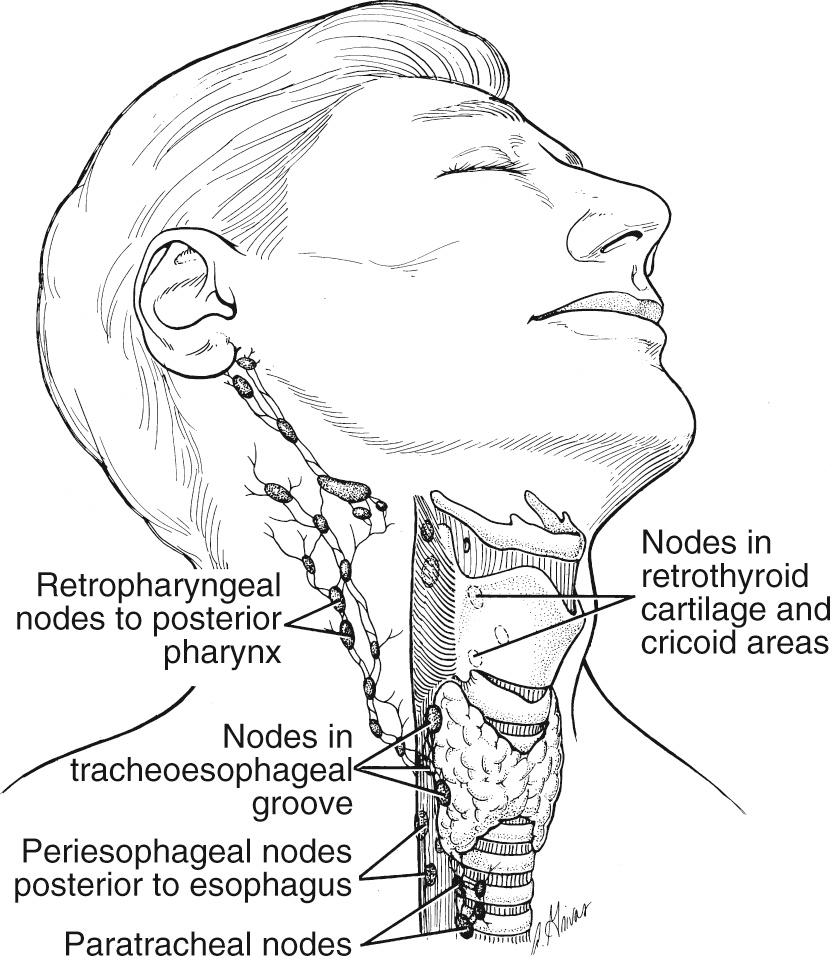 Fig. 101.2, Hypopharyngeal carcinomas metastasize primarily to the superior jugular and midjugular nodes. However, metastasis to the retropharyngeal, paratracheal, paraesophageal, and parapharyngeal space nodes may be present.