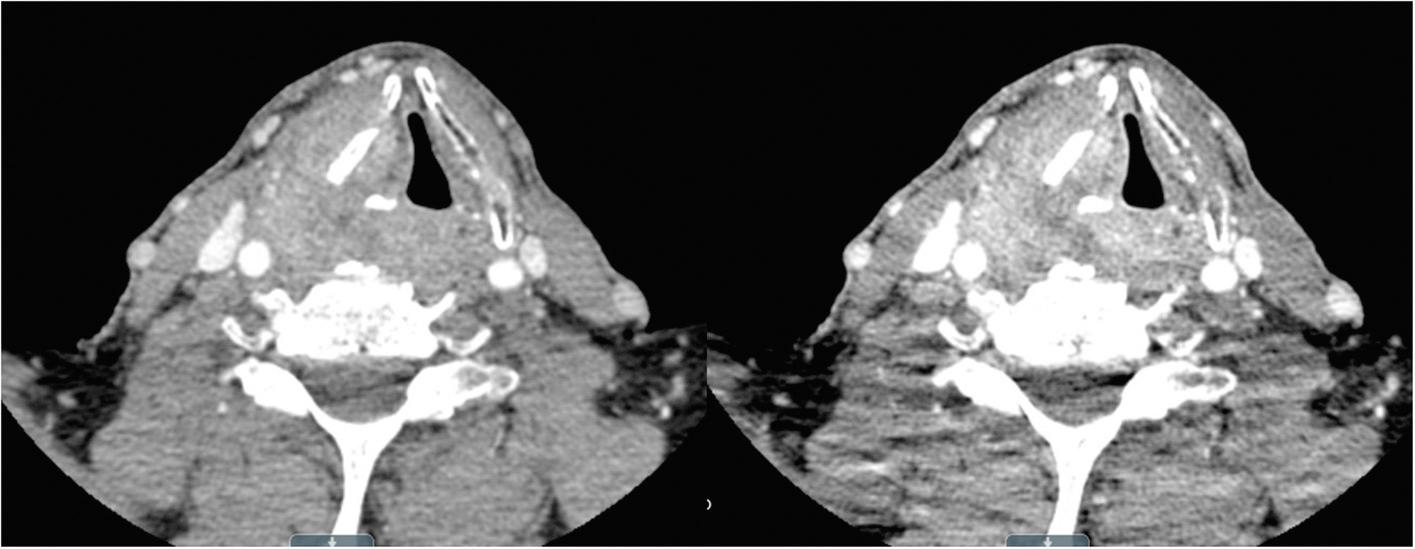 Fig. 101.3, Dual-energy axial computed tomography scan of a patient with a right piriform squamous cell carcinoma that invaded the arytenoid cartilage and the thyroid lamina. The left panel is at 70 keV and the right panel is at 45 keV, showing the differences in the dual-energy techniques to highlight cartilaginous invasion.