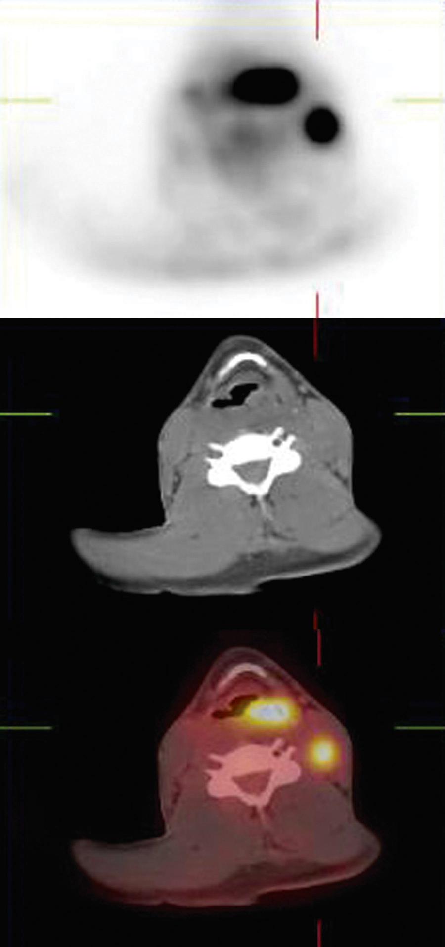 Fig. 101.4, Positron emission tomography (PET), computed tomography (CT), and PET-CT fusion images in a patient with an advanced left piriform sinus squamous cell carcinoma with cervical lymphadenopathy. The top panel shows the PET image alone, and the middle panel shows the CT alone. The bottom panel shows the PET-CT fusion images.